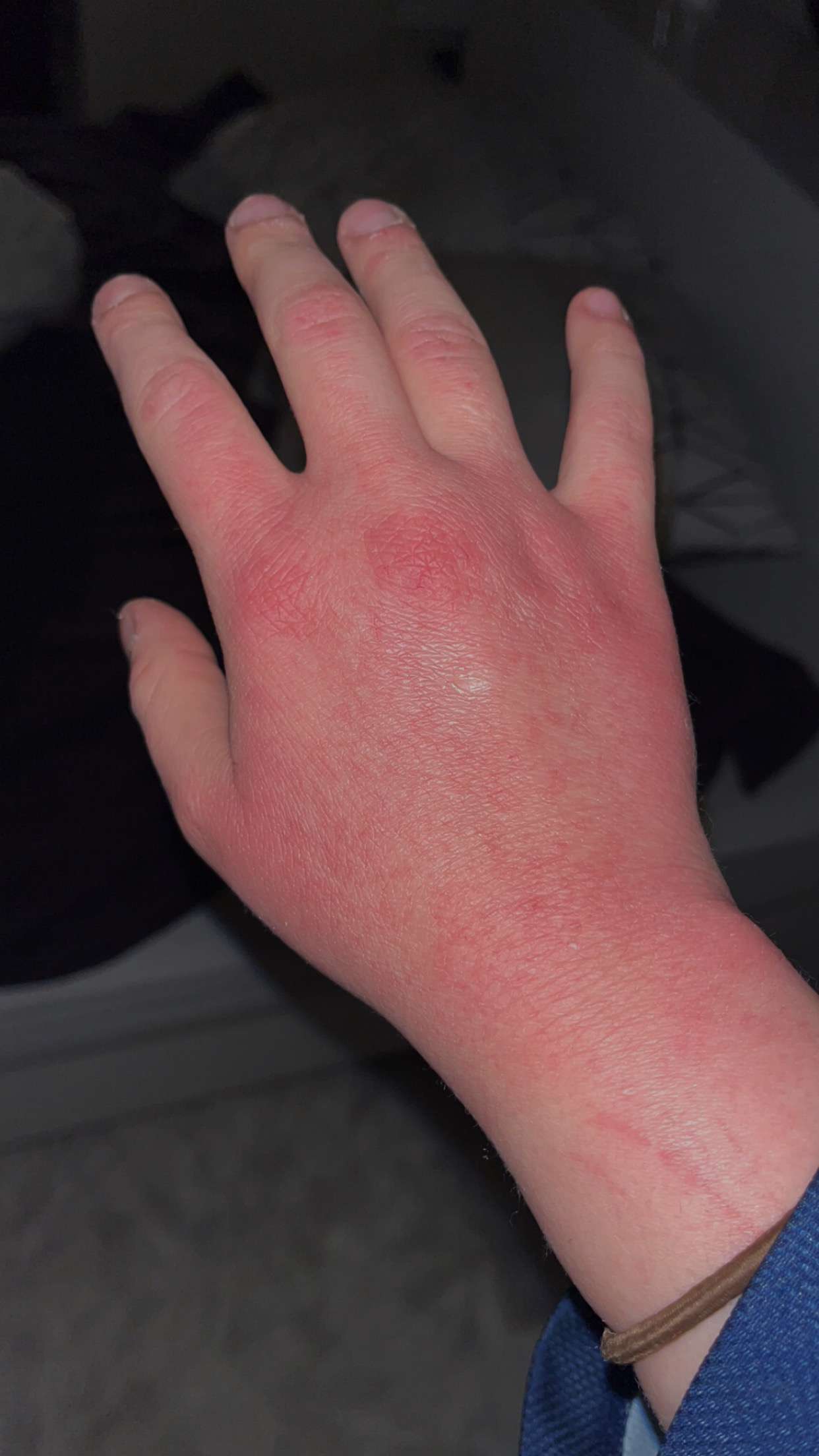 Depuis 3j j&rsquo;ai la main en feu c&rsquo;est rouge vif et je souffre tellement &ccedil;a me brule j&rsquo;ai des milliers de mini creuvasses 🥲🥲