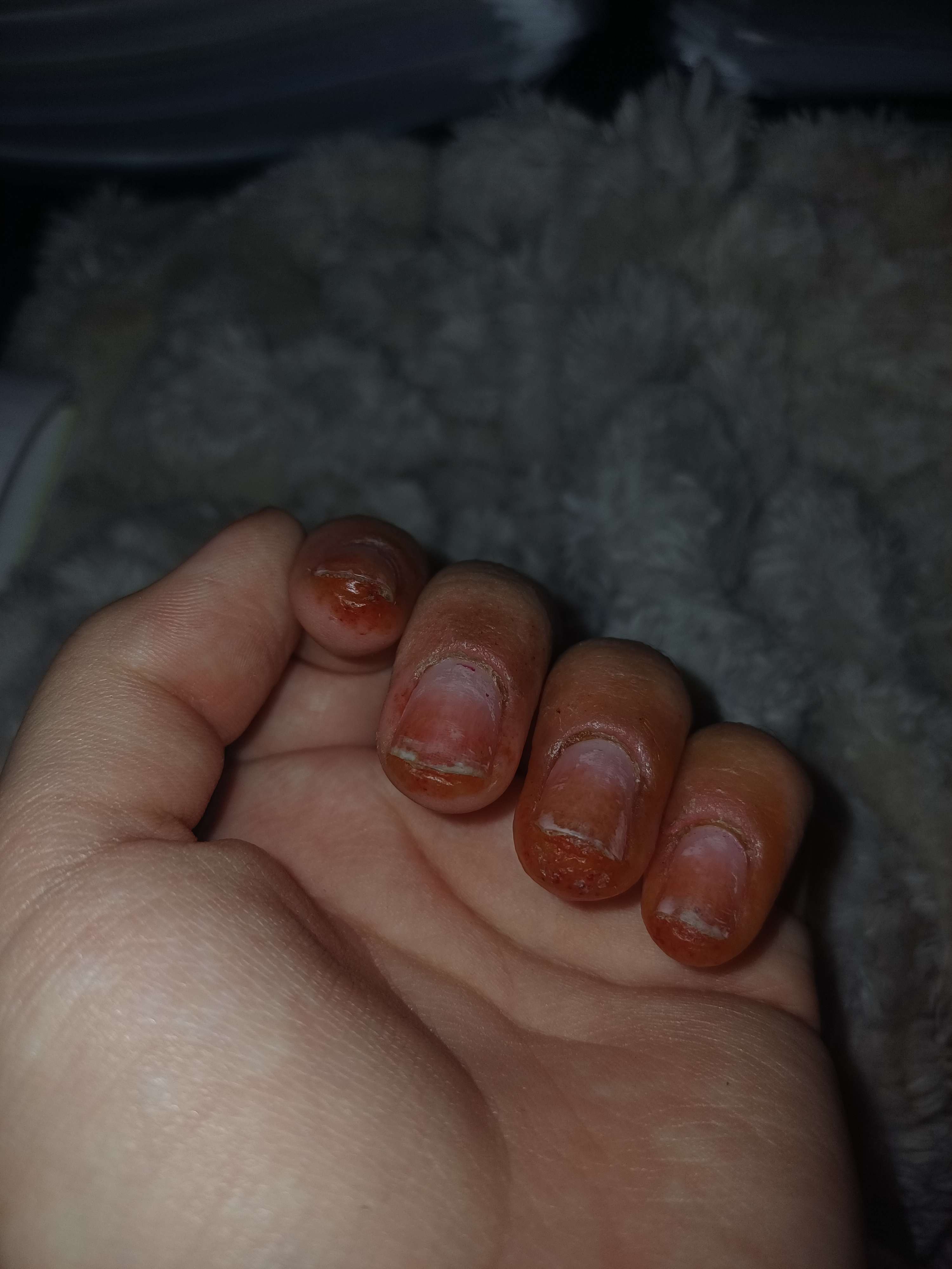 ya 3 semaines j'ai fais une allergie au semi permanent faites vrm attention les girls